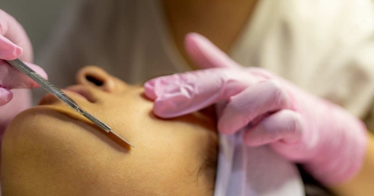A therapist in pink gloves gently dermaplaning a client's cheek with a blade during a dermaplaning treatment